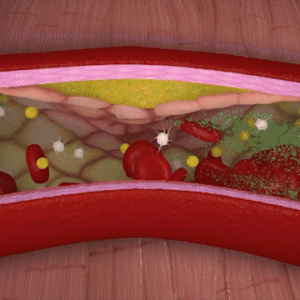 atherosclerosis